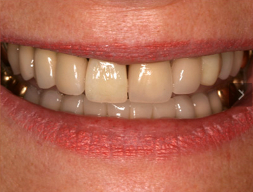 Front tooth restoration at Willow Pass Dental Care