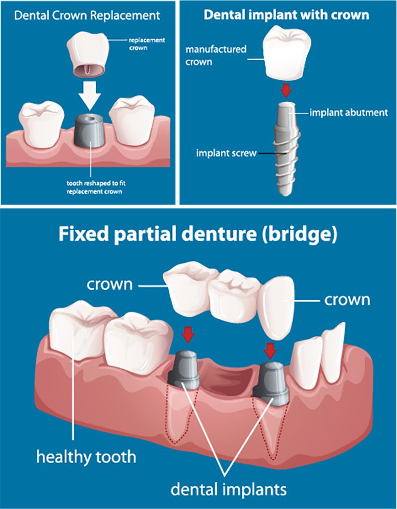 willowpassdentalcare-dental-implants-illust-800x1024.jpg