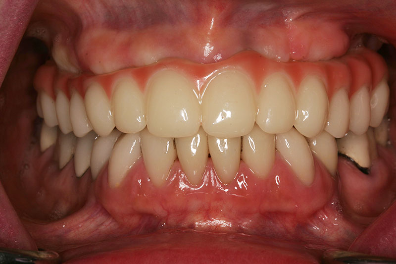 Willow Pass Dental Care patient after implant denture treatment.
