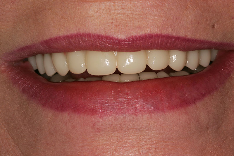 Willow Pass Dental Care patient after implant denture treatment