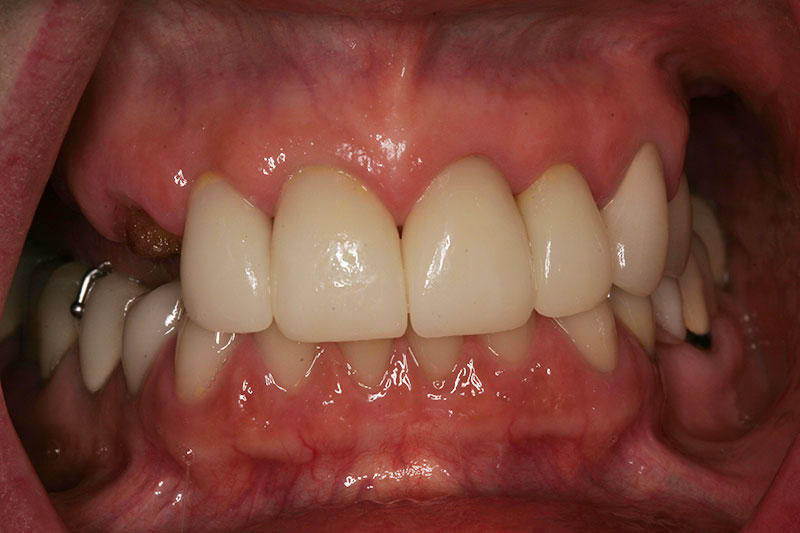 Willow Pass Dental Care patient before implant denture treatment.