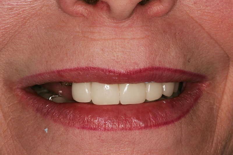 Beverly before implant denture treatment at Willow Pass Dental Care