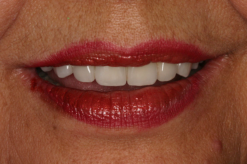 Full mouth reconstruction patient at Willow Pass Dental Care