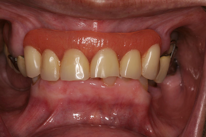 Patient before full mouth reconstruction at Willow Pass Dental Care