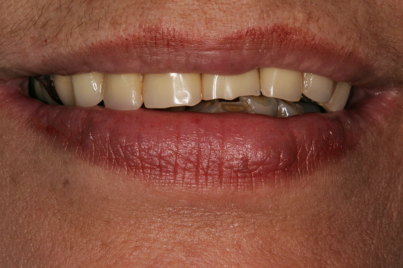 Before full mouth reconstruction at Willow Pass Dental Care