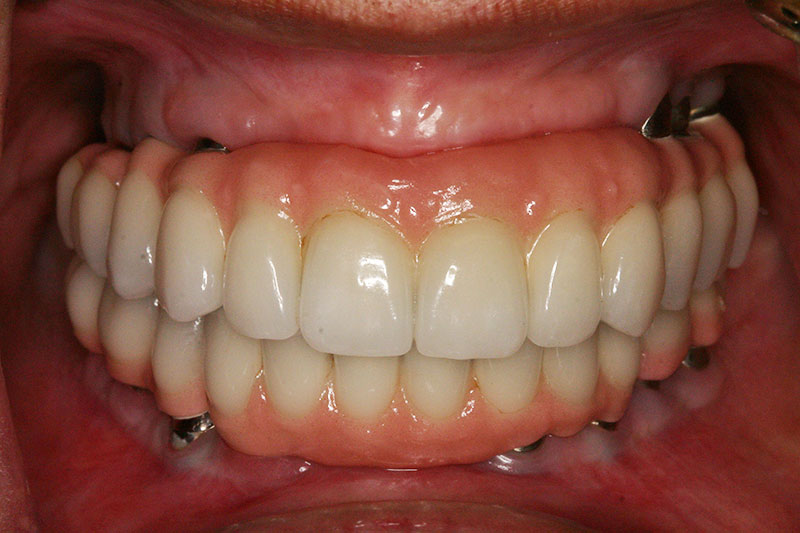After photo of patient with full mouth reconstruction at Willow Pass Dental Care