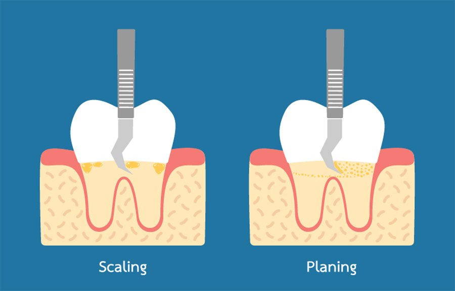 Scaling and planing - Willow Pass Dental Care, Concord,CA Dentist