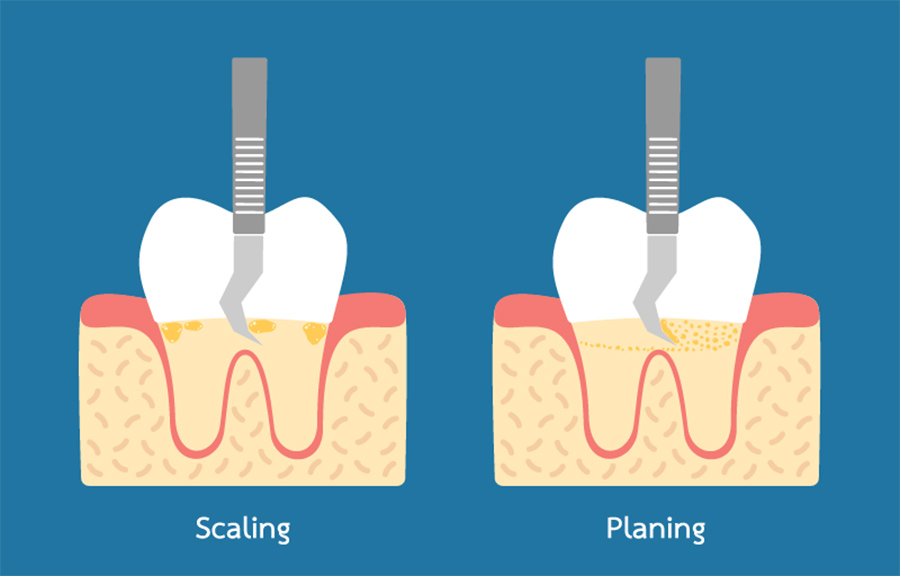 scaling and planing - Concord,CA Dentist