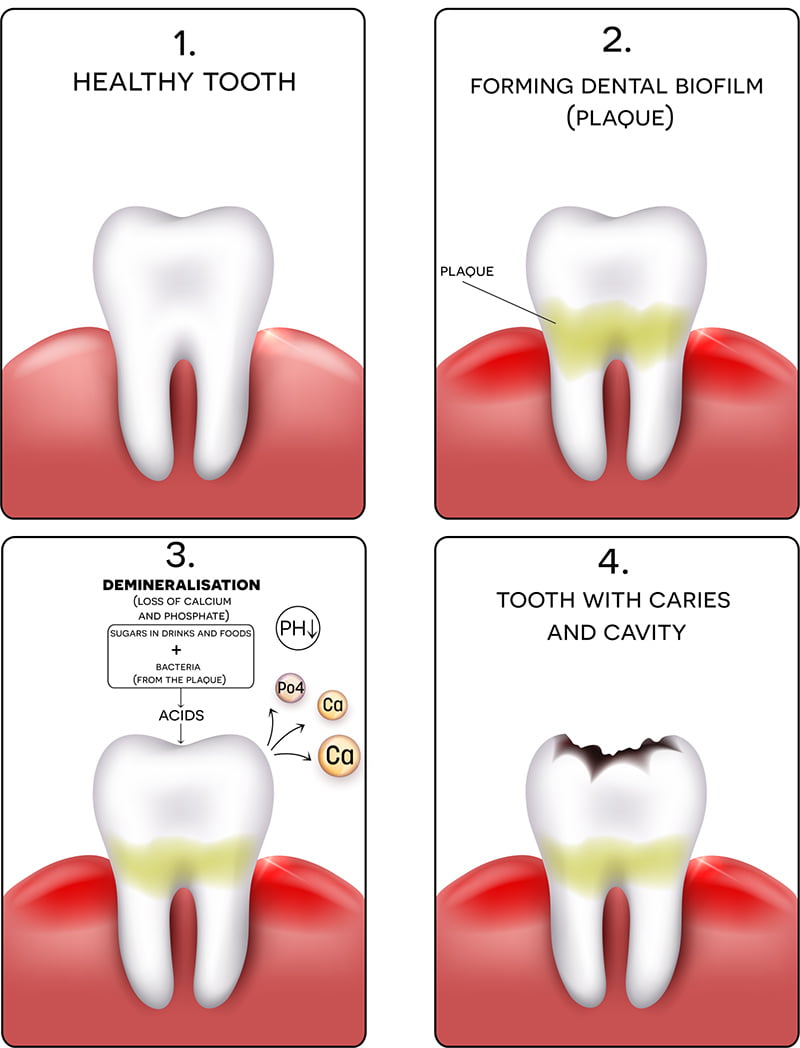 Teeth Cleaning - Remove Plaque