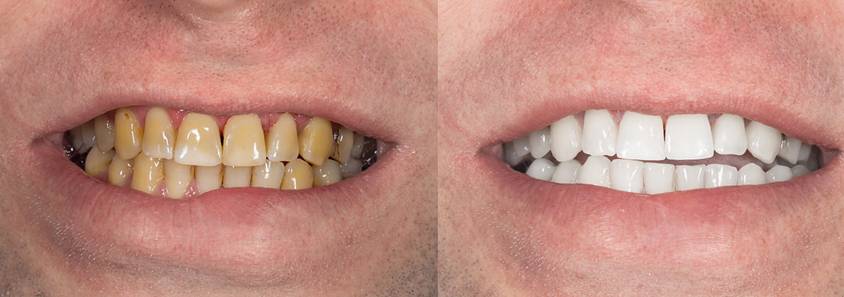 Yellow Teeth vs. White Teeth