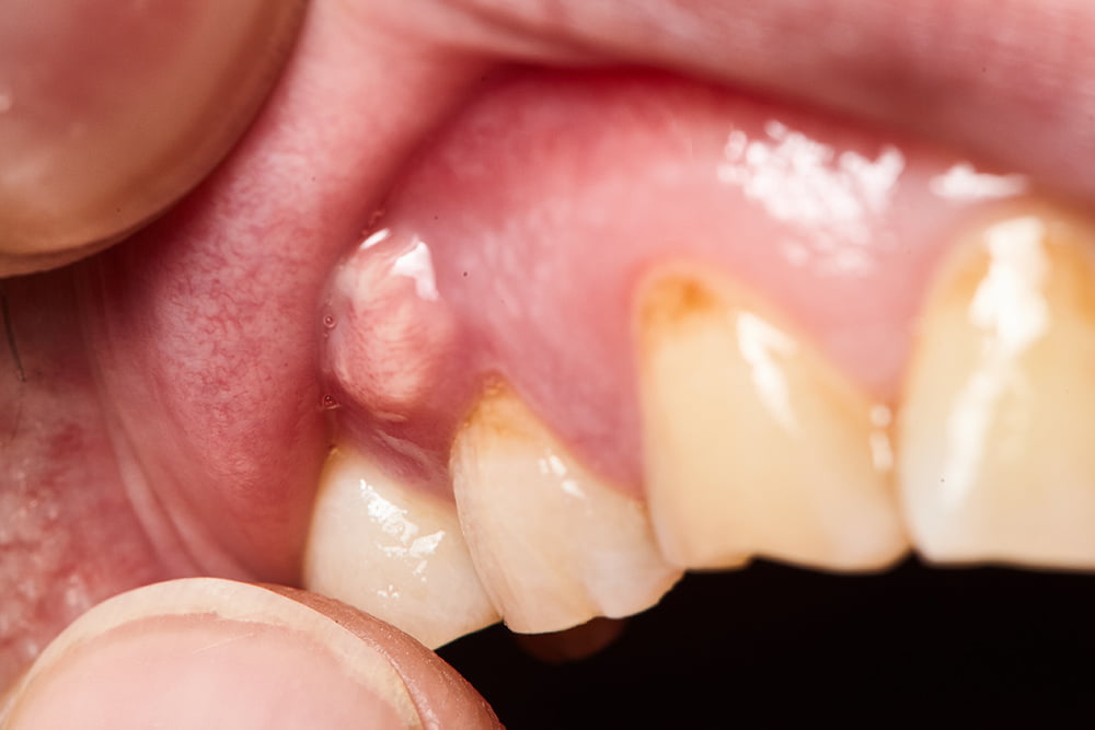 Bumps on gums - Concord Ca Dentist