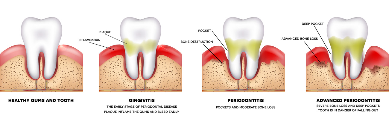 Illustration of Periodontitis - Inflammation of the Gums - Dr. Reza Khazaie, DDS