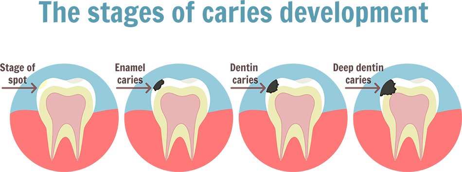 Stages of Dental Caries Development - Willow Pass Dental Care - Concord, CA