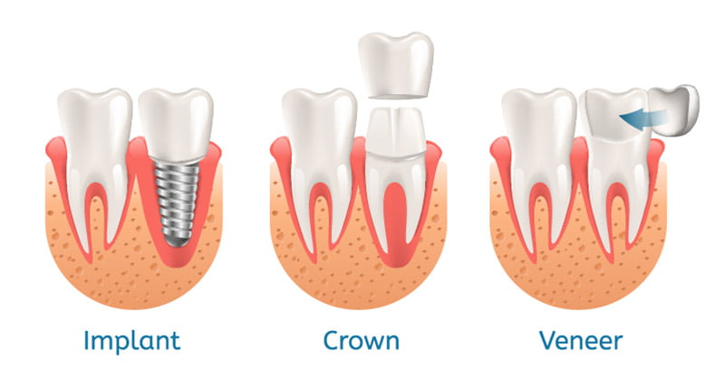 Dental Implant vs Dental Crown vs. Dental Veneer