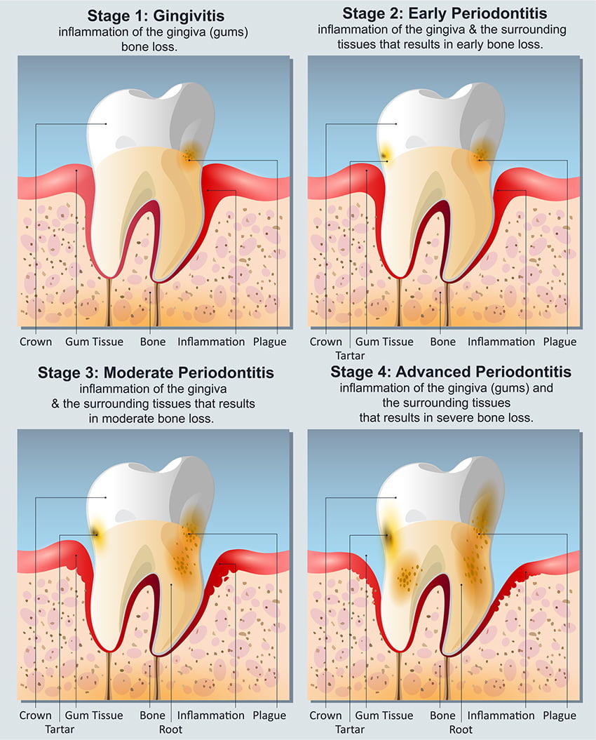 Stages of Gum Diseas - Concord Dentists