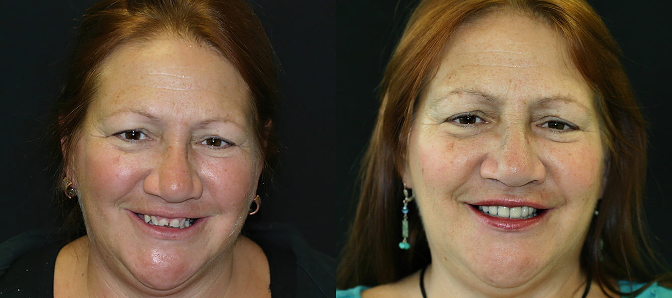 Before and After Smile Makeover - Concord Dentist