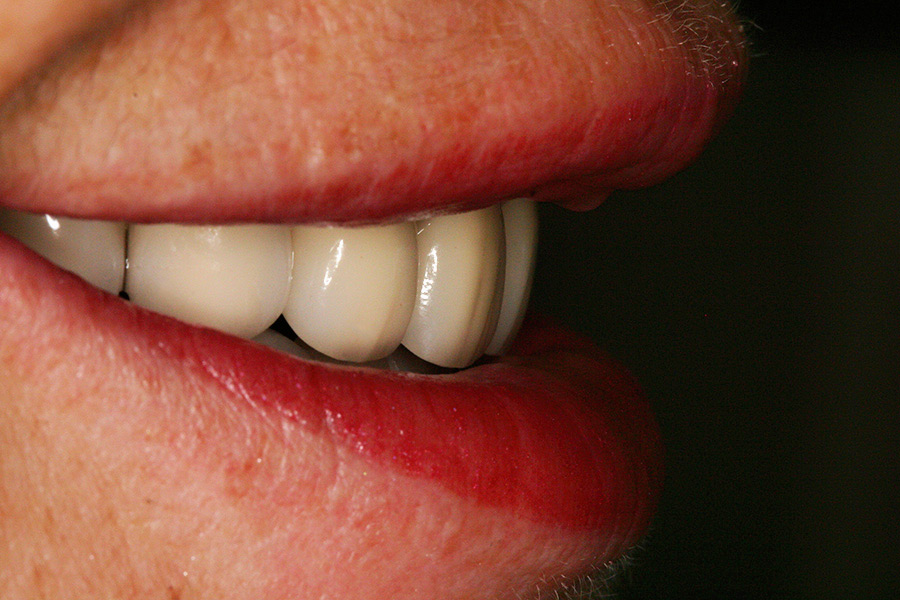 Full Mouth Reconstruction Kathleen Willow Pass Dental Care