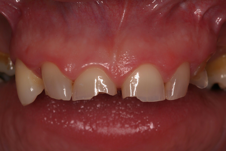 Full Mouth Reconstruction Kathleen Willow Pass Dental Care