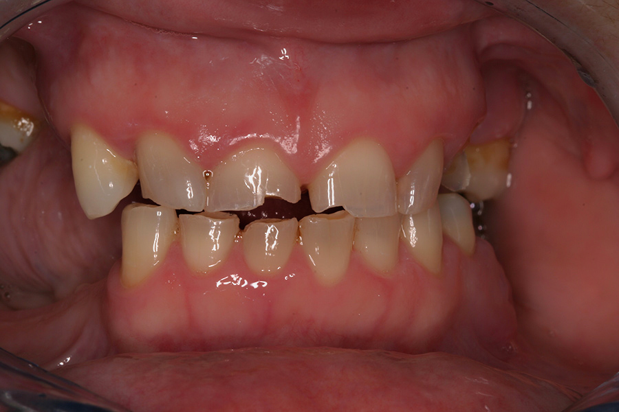 Full Mouth Reconstruction Kathleen Willow Pass Dental Care