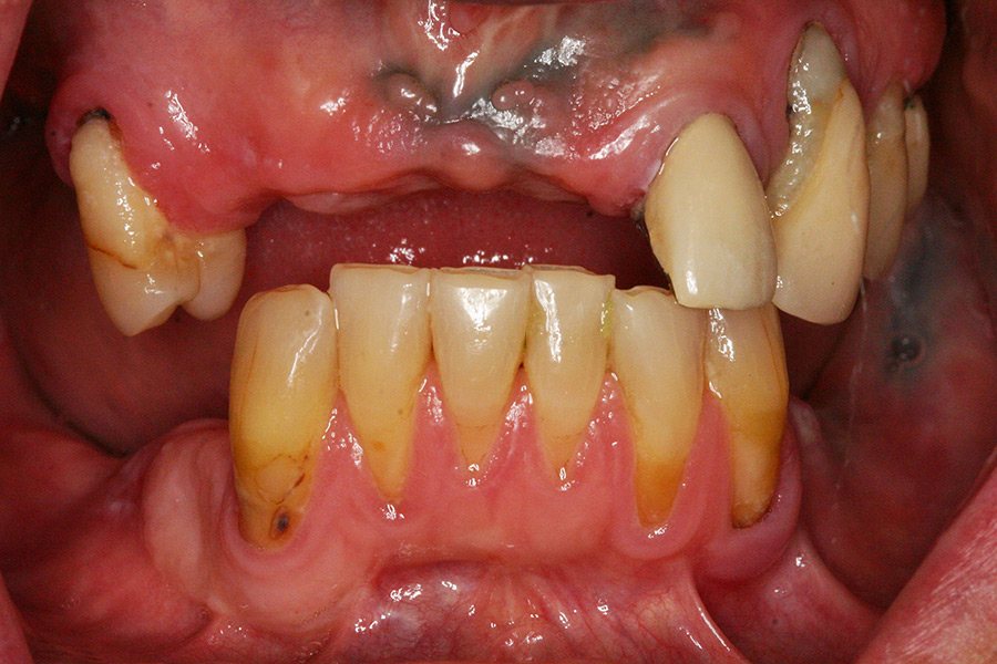 photo of patient before dental reconstruction
