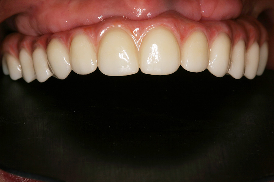 Patient dental prosthesis for all-on-4 treatment.