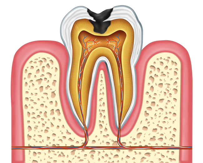 Anatomy of a Cavity - Dentist in Concord, CA
