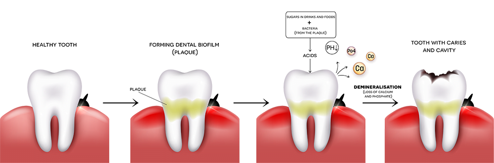 Tooth Decay - Plaque - Cavities
