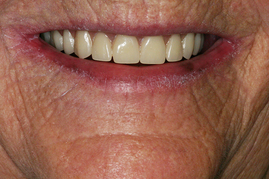 Patient smiling after full mouth reconstruction treatment with dentures and all-on-4 dental implants.