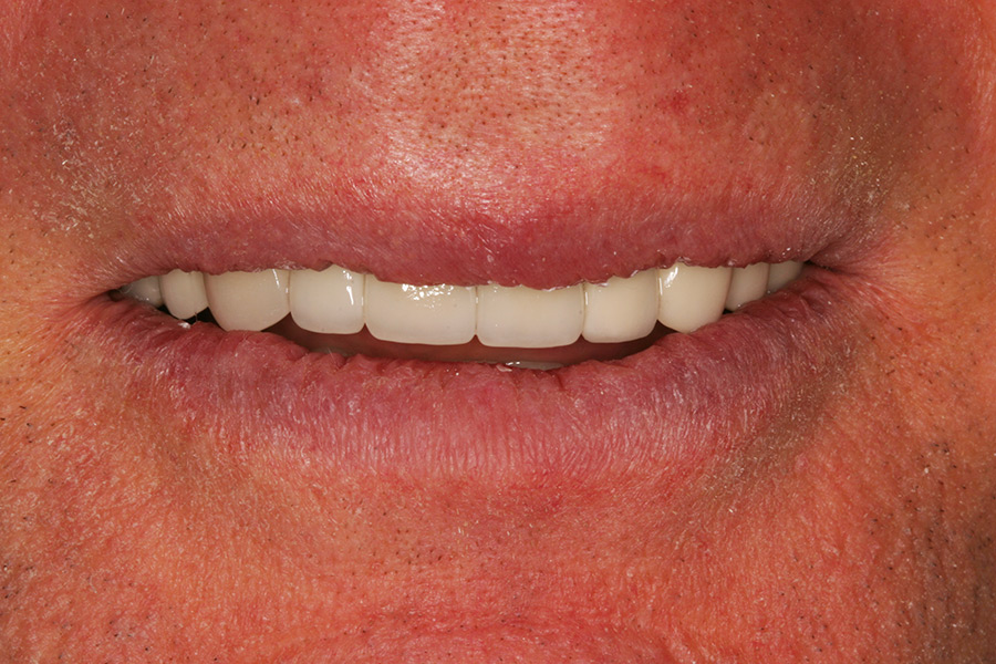 Patient after treatment with dental crowns and dental implants.