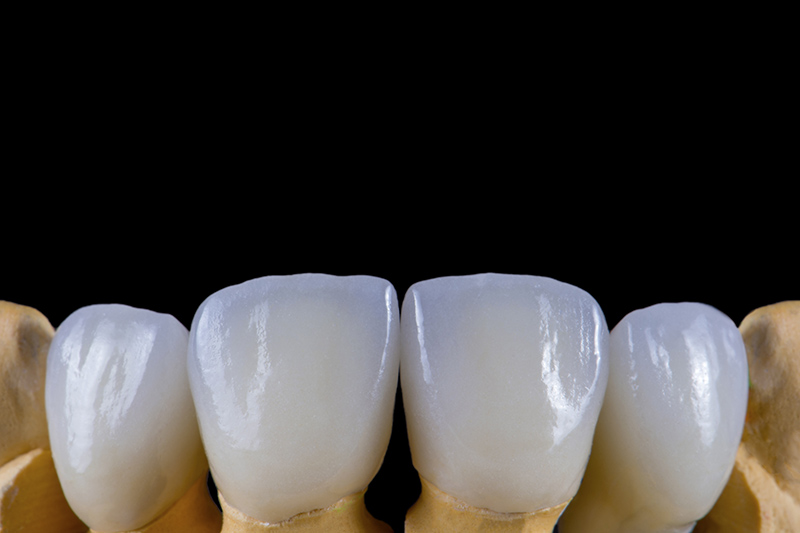Dental crowns just like real teeth