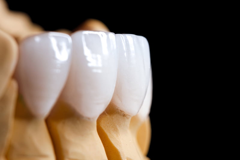 Dental Crown Benefit: Longevity