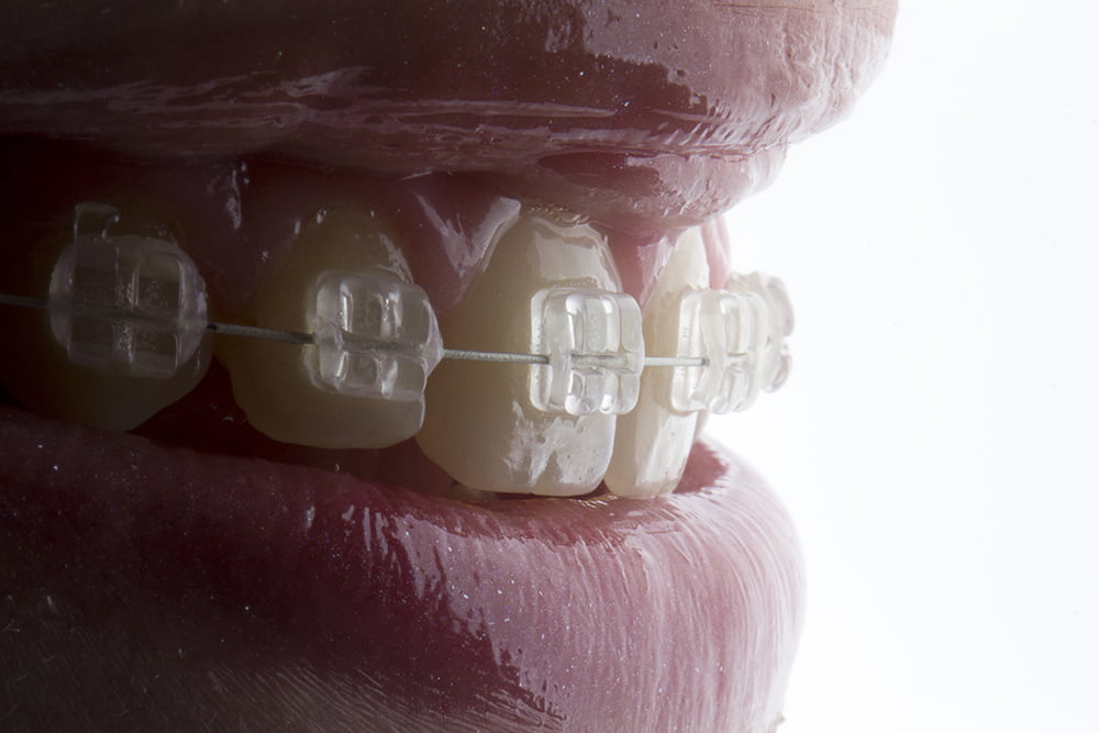 Orthodontic treatment - Concord, CA Dentist