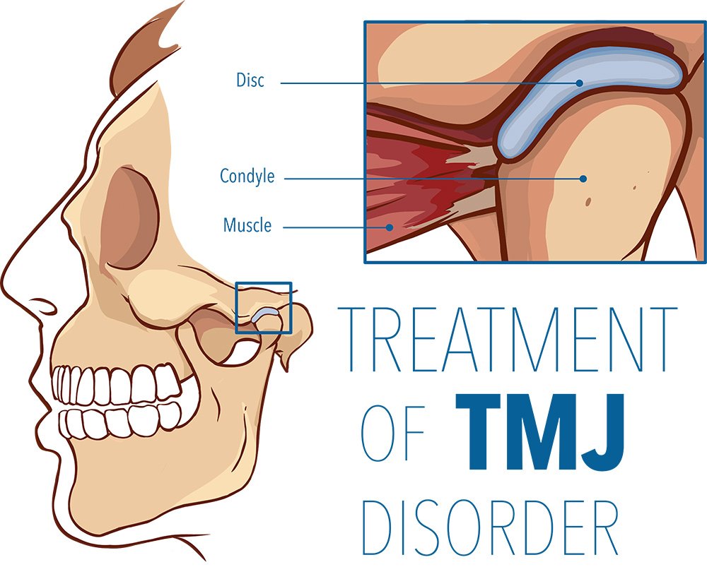 Treatment of TMJ - Dentist in Concord, CA
