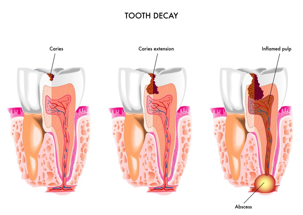 Dental Caries - Tooth Decay - Concord Dental
