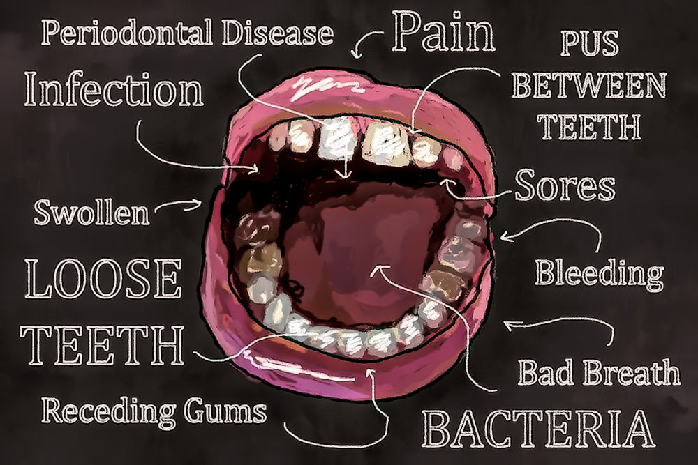 Periodontal Disease - Concord Dental