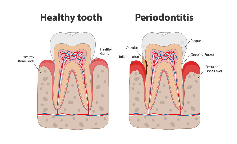 Periodontitis - Dental Plaque