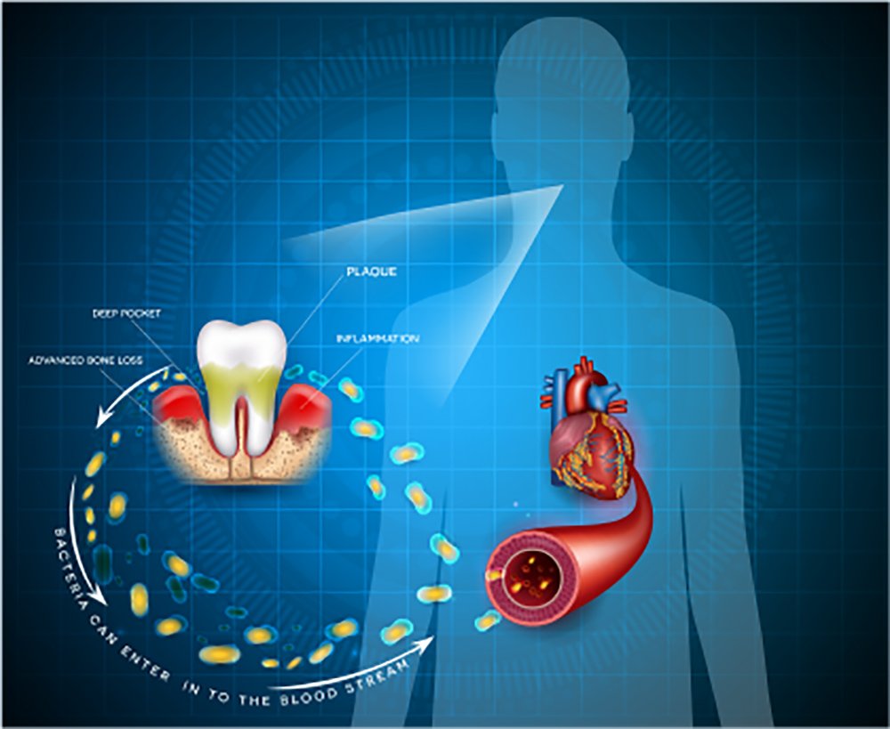 Chronic oral inflammation and heart disease