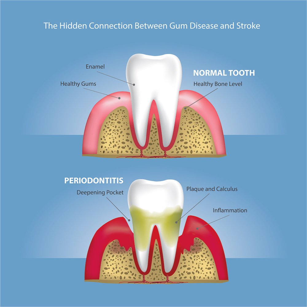 Gum Disease and Stroke