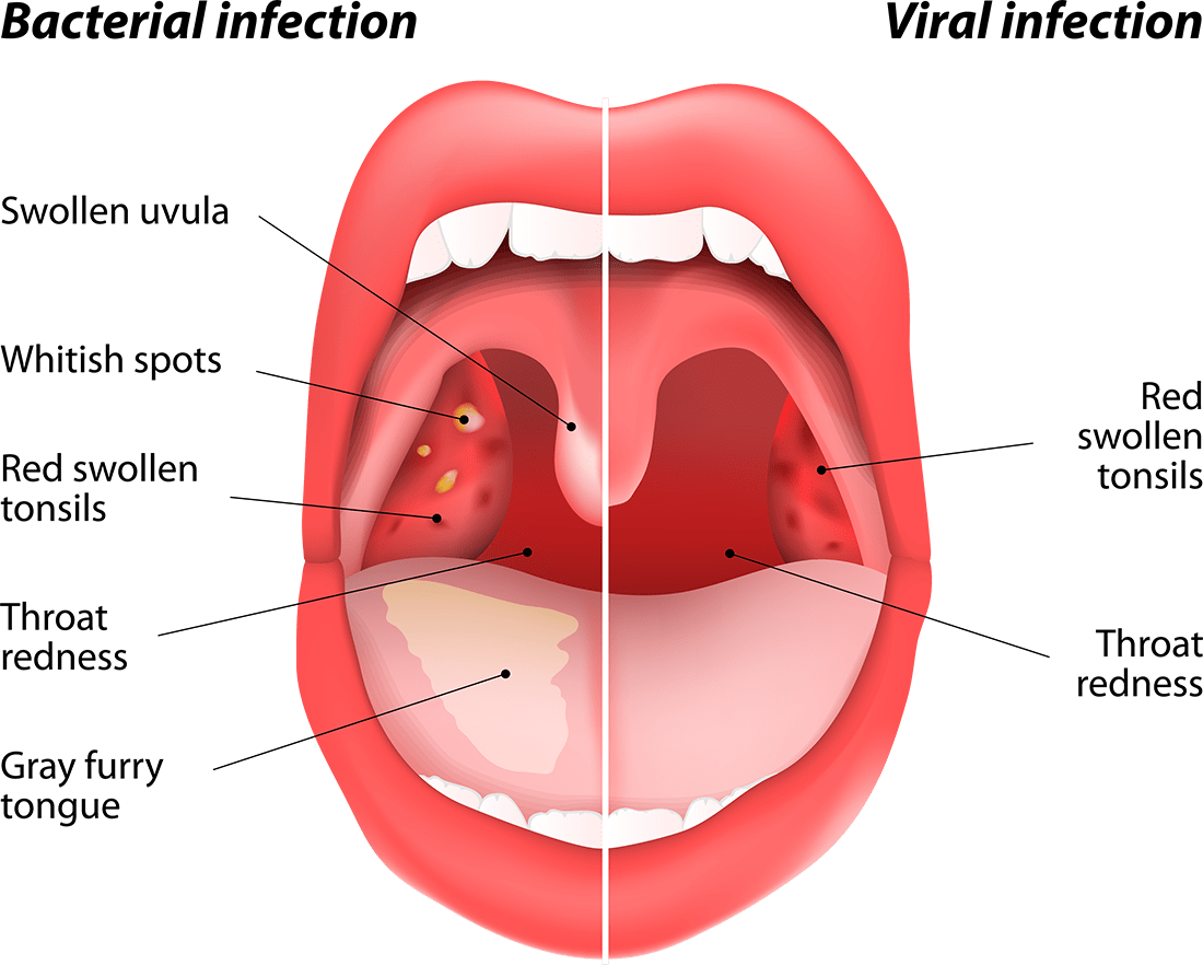 Mouth Infections