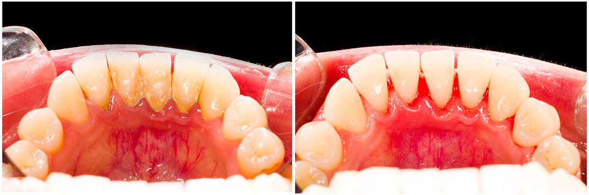 Concord CA Dentist - Teeth Whitening