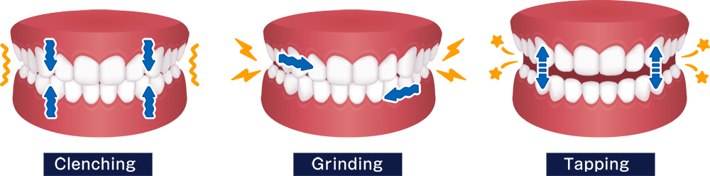 Types of Bruxism - Teeth Grinding - Willow Pass Dental Care - Concord, CA dentist