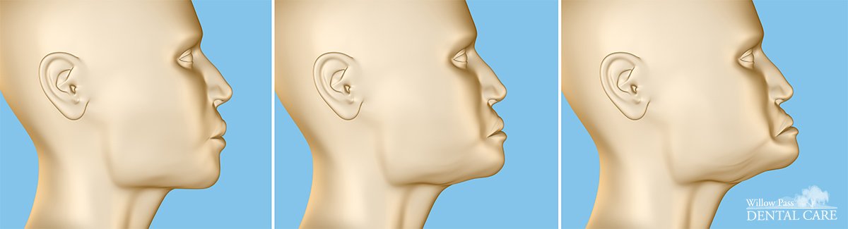Prevents sunken face - dental implants