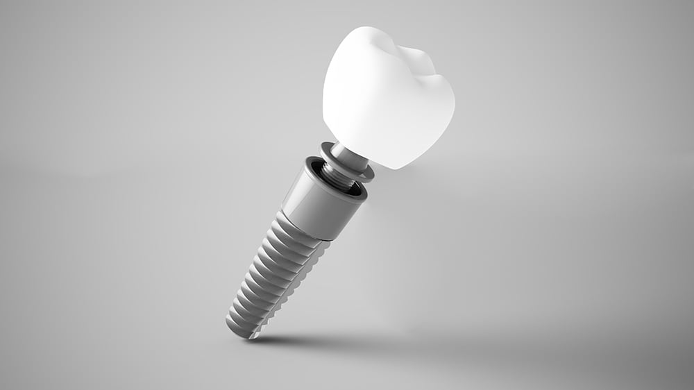 What is a dental implant