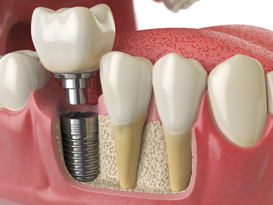 Dental implant post placed in jaw bone