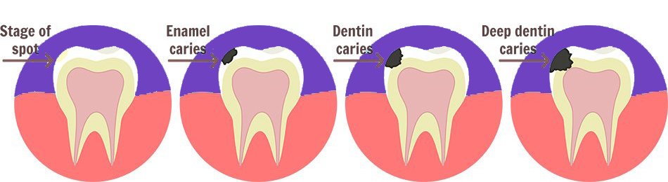 The Stages of Caries Development - Willow Pass Dental Care - Concord, CA