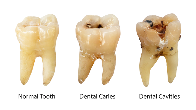 Dental Cavities vs. Caries - Concord, CA Dentist