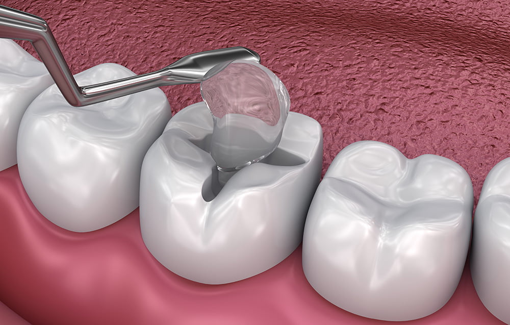 How does a cavity filling work? - Willow Pass Dental Care - Concord, CA