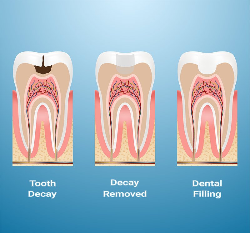 How does a cavity filling work? - Willow Pass Dental Care - Concord, CA