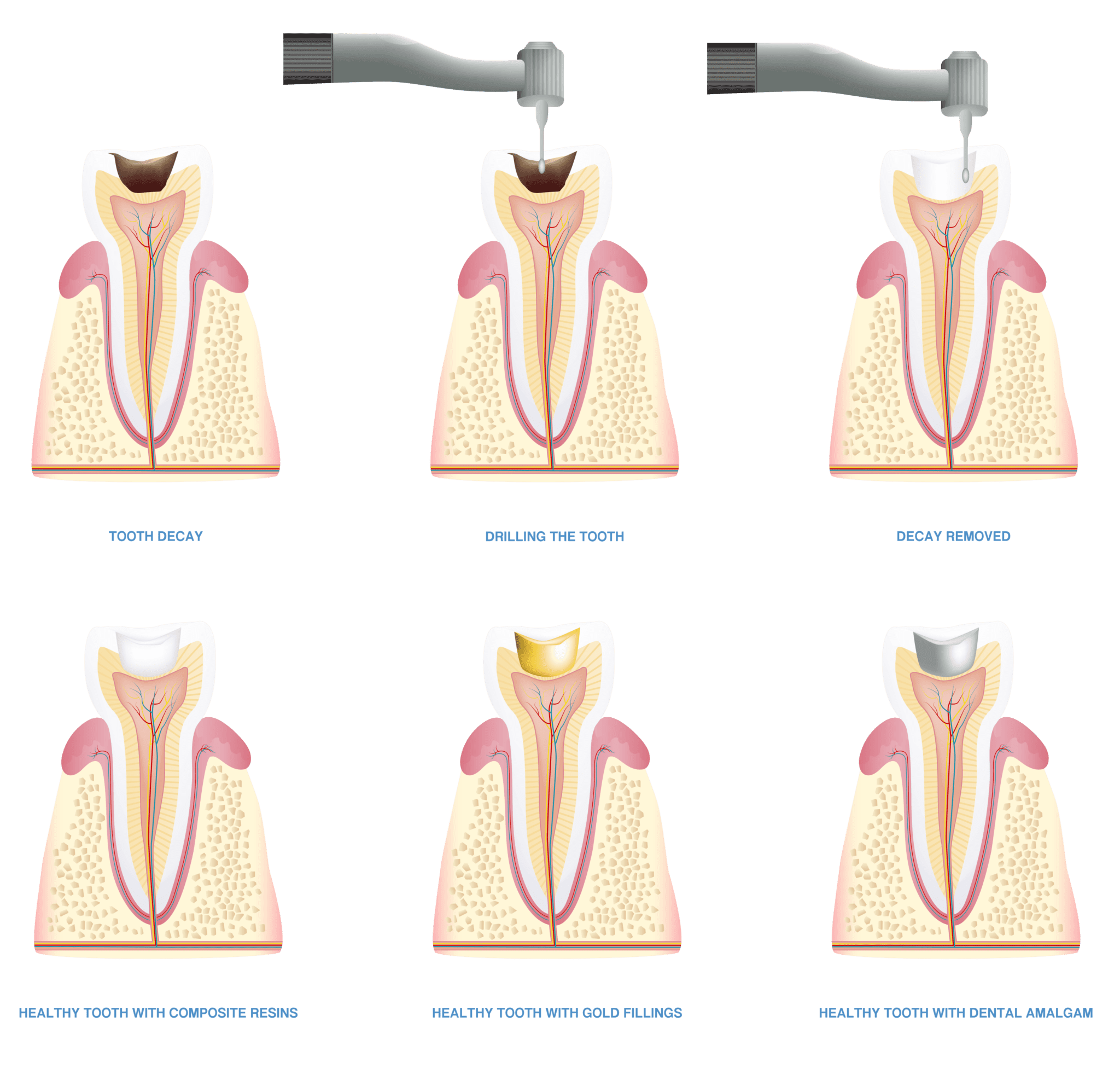 How Does A Cavity Filling Work? Willow Pass Dental Care