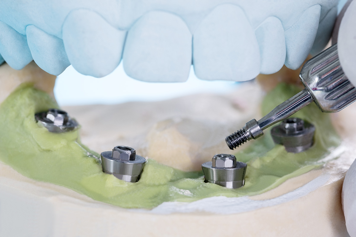 Abutments - Dental Implants, Concord, CA